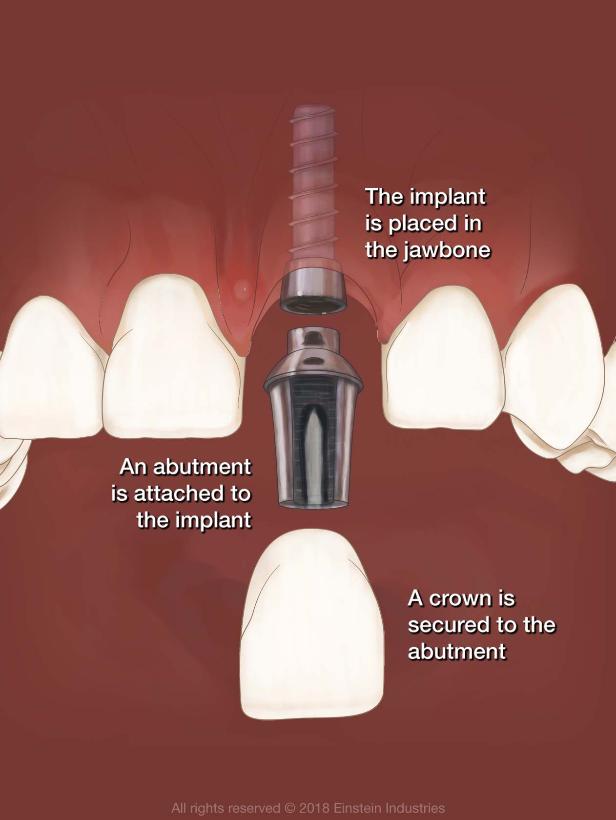 Illustration showing the implant is placed in the jawbone, an abutment is attached to the implant, and a crown is secured to the abutment